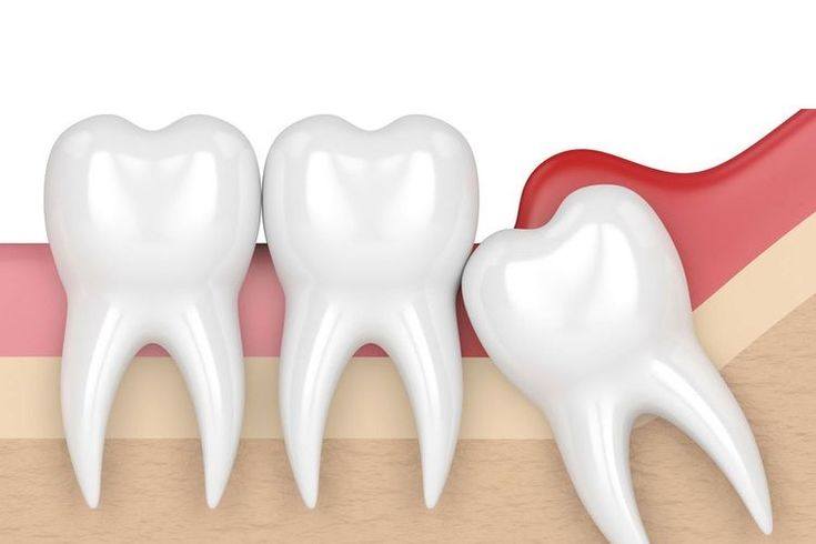 Răng Khôn Mọc Lệch: Những Tác Hại Không Thể Xem Nhẹ