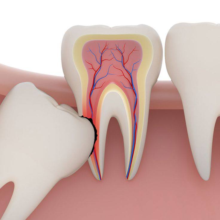 Răng Khôn Mọc Lệch: Những Tác Hại Không Thể Xem Nhẹ