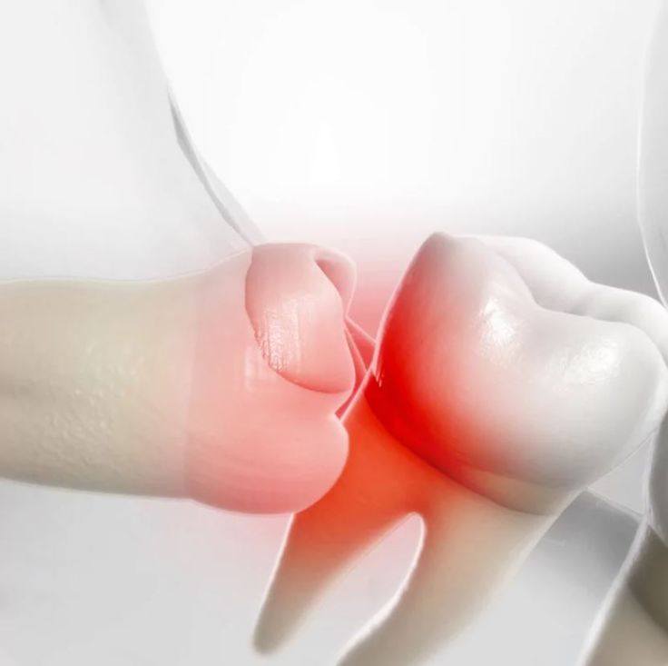 Răng Khôn Mọc Lệch: Những Tác Hại Không Thể Xem Nhẹ