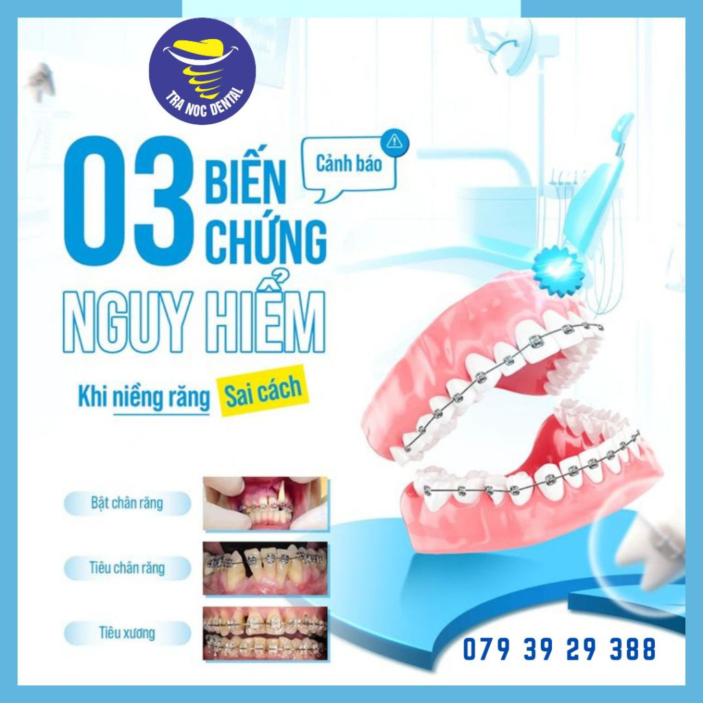 3 Biến Chứng Nguy Hiểm Khi Niềng Răng Sai Cách Và Cách Phòng Tránh