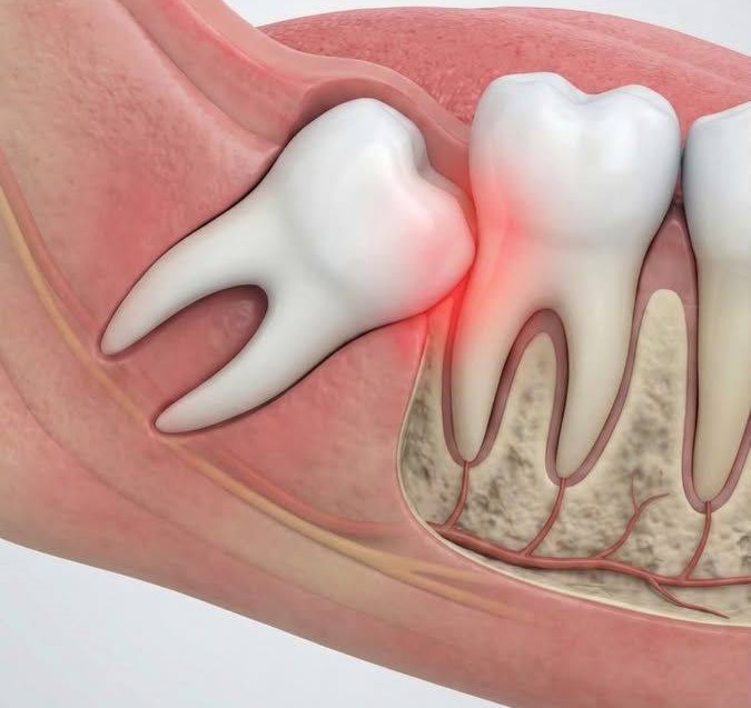 Răng Khôn Mọc Lệch: Những Tác Hại Không Thể Xem Nhẹ