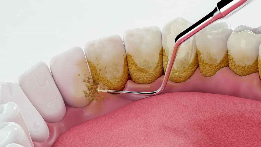 Làm Sạch Cao Răng - Giải Pháp Chủ Động Ngăn Ngừa Bệnh Lý Răng Miệng Nghiêm Trọng
