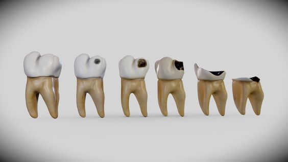 Sự phá hủy của sâu răng - Đừng để răng tổn thương trong âm thầm